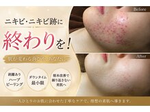 エヌア(ENUA)の雰囲気（ニキビ・シミ・などの肌トラブルにハーブピーリングで根本ケア）