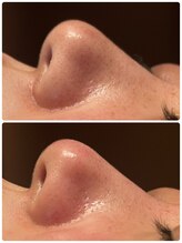 ディオーネ 春日井勝川店(Dione)/毛穴洗浄☆ビフォーアフター