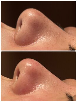 ディオーネ 春日井勝川店(Dione)/毛穴洗浄☆ビフォーアフター