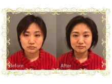 レメディ/美容鍼コース