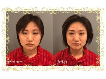 レメディ/美容鍼コース