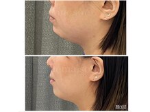 アエ メゾン(ae maison)/顔3回後