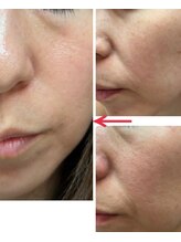 エステティックセラピー プレマ(PREMA)/純粋レチノールによる若見え改善