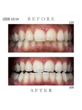 エンルーチェ プラスエイト(en;Luce+8)/ホワイトニング1回