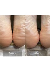 ベルタ(Belta)/韓国式最新角質ケアS-PLANNING