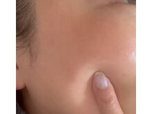 ミラリア(mirallia)の雰囲気(剥離なし◎話題のハーブピーリングで明るくもちもち素肌へ♪)