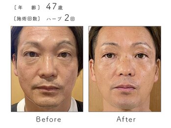 チップ(chip)/47歳/施術2回