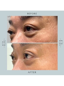 スプレール 水戸店/ExoLif(エクソリフト)