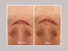 エスラボ オオサカ 心斎橋/毛穴洗浄×ハーブピーリング