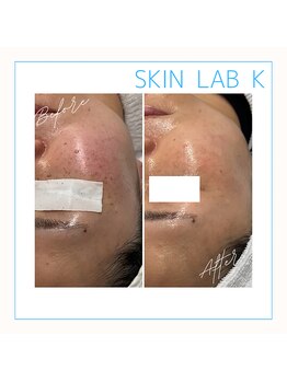 スキン ラボ ケー(Skin lab K)/プラズマシミケア