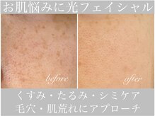 アリスビューティー(AliceBeauty)/シミ・くすみにアプローチ◎