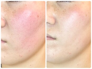 ラウン 京都(ROUN')/8回の施術ビフォーアフター