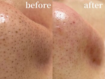 ラティエル(Latiele)/毛穴エクストラクション