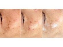 ジン フォー ユアビューティー(JIN for your beauty)/施術経過