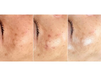 ジン フォー ユアビューティー(JIN for your beauty)/施術経過