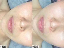 アンドミー 福岡博多店(&me)/ララピール【艶肌/美白/くすみ】