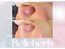 ベルハーブ(Belle herb)/30代/ハーブピーリング/毛穴乾燥
