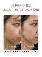 アルセ(arce)/美顔器+エニシースキンケア