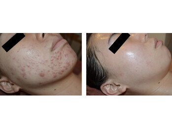 エクボ(EcBeau)/水光ピーリング