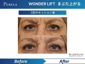 ピュアラ 心斎橋店/WONDER　LIFTまぶた上がる