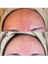 ユフラ(Juhla)/韓国式ハーブピーリング