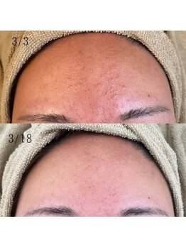 ユフラ(Juhla)/韓国式ハーブピーリング