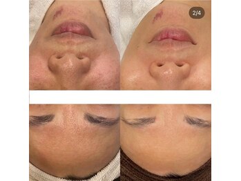 シール(Syl)/プロセルセラピーズ症例