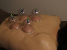 アヴリール(avril)/解消しない深いコリはカッピング