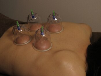 アヴリール(avril)/解消しない深いコリはカッピング