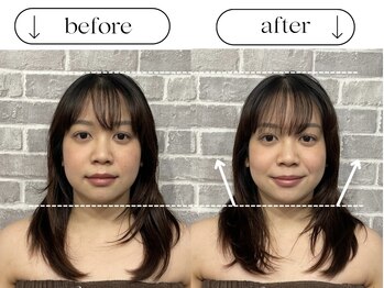 ビースタイル(B-style)/【電気美容鍼】ビフォーアフター