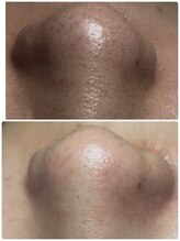 メディカルエステ ユウ(Yuu)/毛穴黒ずみケア