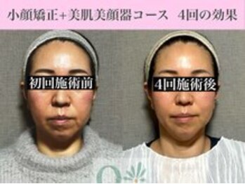 キュープ 福岡九大学研都市店(Qpu)/美顔器モニターコース４回の変化