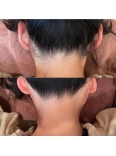 ティアラ(TIARA)/うなじ脱毛