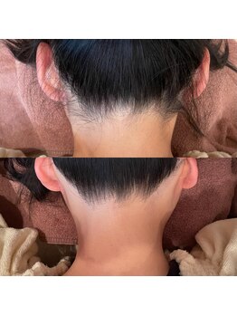 ティアラ(TIARA)/うなじ脱毛