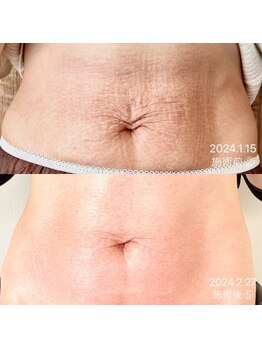 ハチ(Hachi)/Litボディ