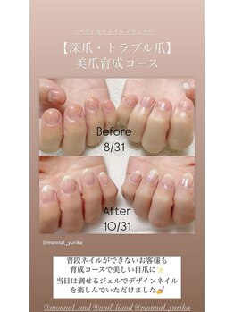 モナールアンド(MONNAL&)/【深爪・トラブル爪】美爪育成
