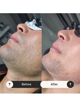 ユーフェム(U-fem)/ヒゲ脱毛10回目のお客様