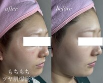 ベイビースキン(Baby skin)