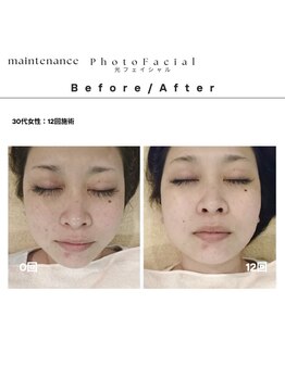 ルーツリー(Rootree)/【メンテナンス】光フェイシャル