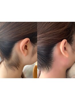 パーツ脱毛のできるサロン