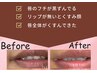《唇リップ》唇のくすみを根本ケア。1回で3年～5年持続。韓国美容のルメラ