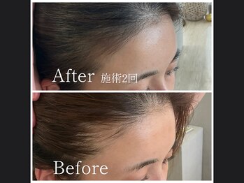 キュライム 熊本(CURAIM)/育毛促進【40代女性】