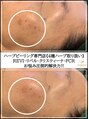 ハーバリー ハーブピーリング 岐阜(HERBERRYハーブピーリング) 毛穴開き 徹底改善