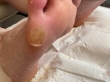 ビサンテ サロン/たこ&魚の目,角質ケア・ビサンテ