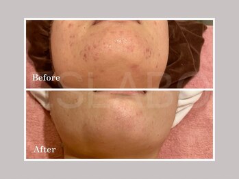 エスラボ オオサカ 心斎橋/剥離無×剥離有ハーブピーリング