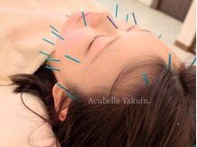 アキュベル 薬院(Acubelle Yakuin.)の雰囲気（お顔の美容鍼）