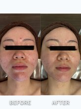 カリズボーテ(karisbeaute)/肌質改善ハーブピーリング