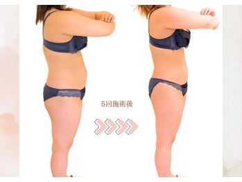 ルナ 千葉(LUNA)/痩身5回施術後