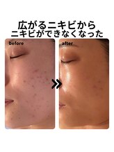 マヴィ(Ma vie)/ニキビ改善