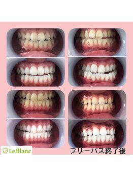 ルブラン 奈良店(Le Blanc)/綺麗な歯 憧れませんか?